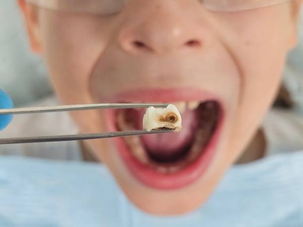 Best Knocked-Out Tooth (Avulsed Tooth) Treatment in Randolph, WI